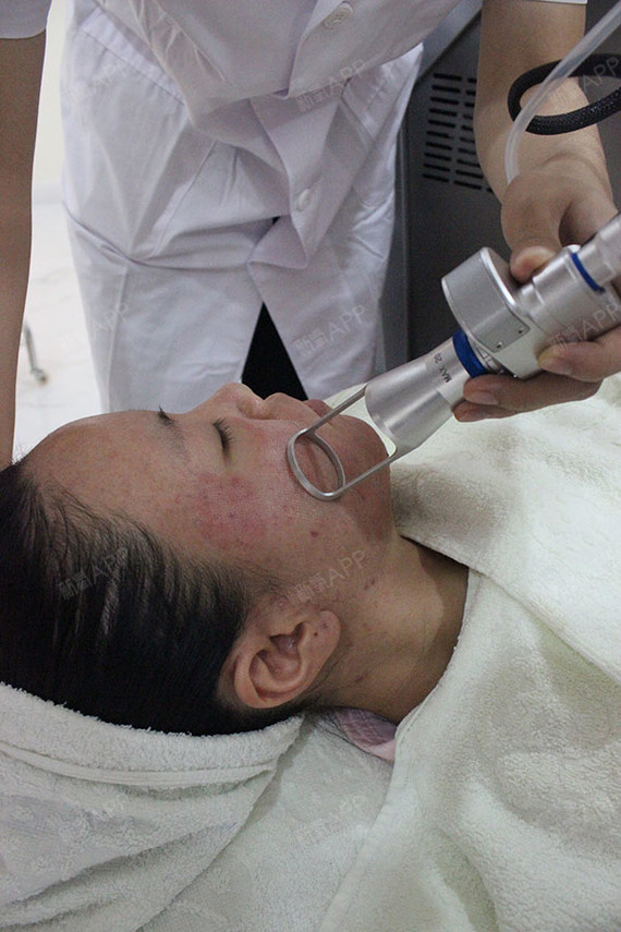 清洁完了就开始做了,点阵激光的激光打上去有种想针扎的感觉,有点红红