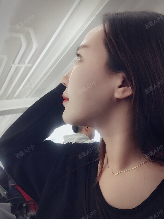 看下侧面,感觉侧面下颌角线条明显许多