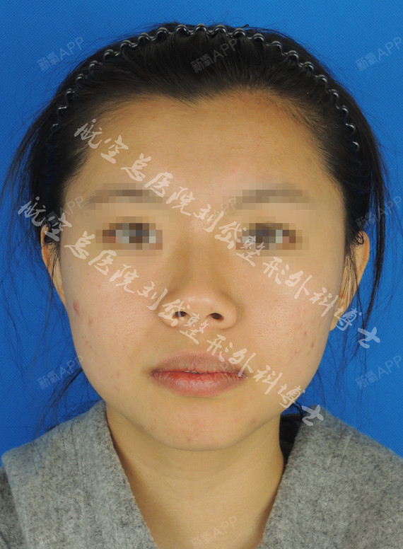 额部中间凹陷,鼻背低平,颏后缩.玻尿酸注射后,面部_圈子-新氧美容整形