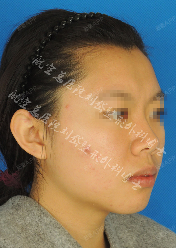 额部中间凹陷,鼻背低平,颏后缩.玻尿酸注射后,面部_圈子-新氧美容整形