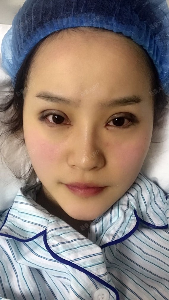 下眼下至术好不好_效果图_可爱女人哦下眼下至术术后第2天_新氧美容