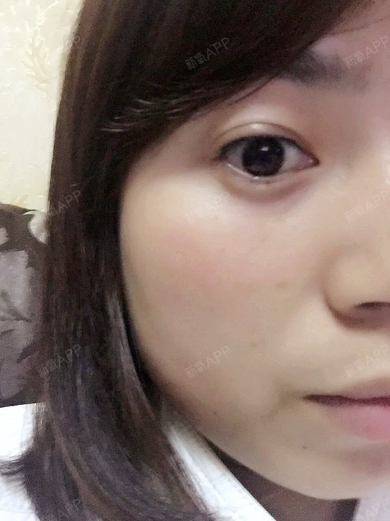 美瞳线第5天,感觉都掉完了,然后微信问了给我纹眼线_圈子-新氧美容