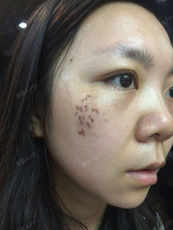 这一侧脸的结痂基本都已经掉完了现在还有点点色沉去医院复诊了王院长