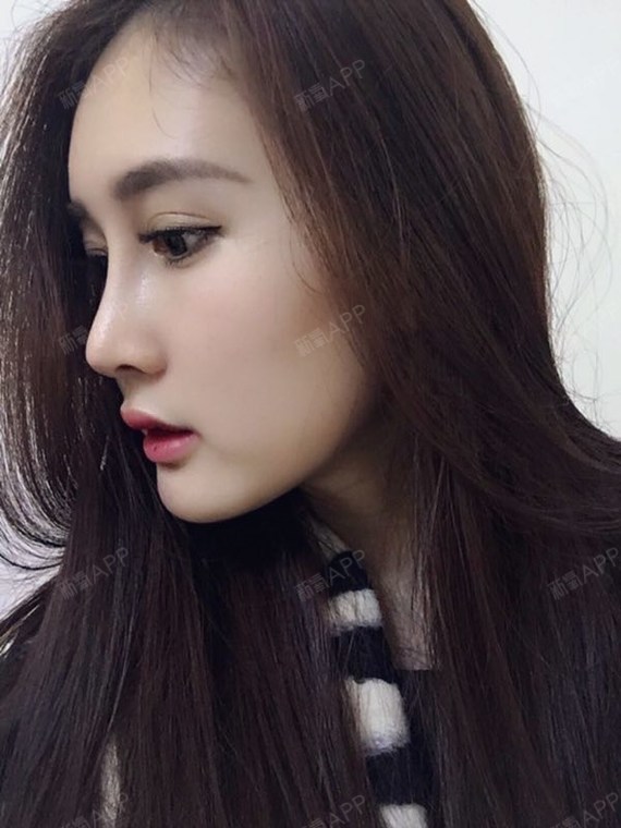 陈桂飞综合小翘鼻第41天#虽然一直都是在深圳待着_圈子-新氧美容整 