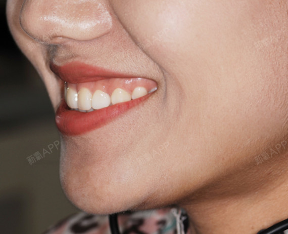 大,影响美观,不敢笑 检查:上前牙散在间隙,2 3间隙偏大,前牙咬合紧,下