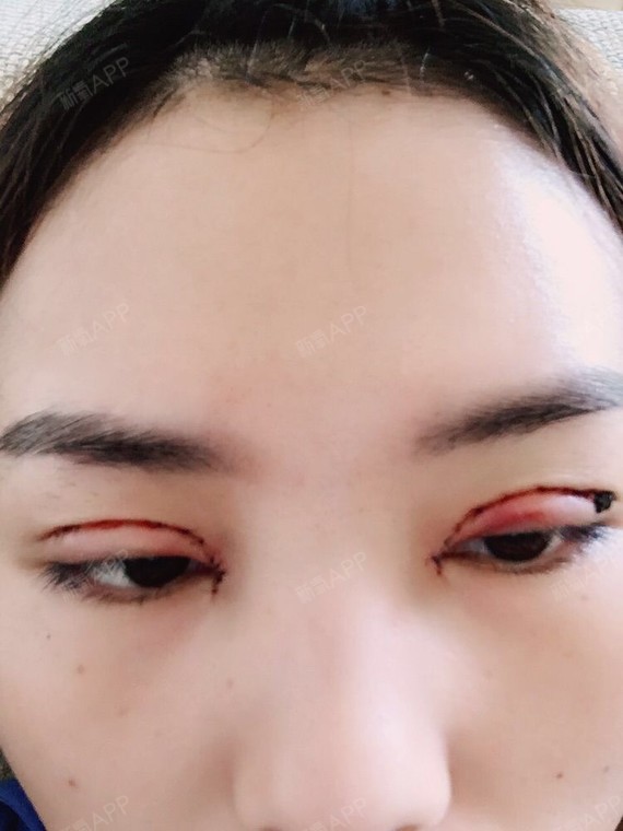 昨天割的双眼皮,开了眼角,jms看看宽不宽啊,感觉_圈子-新氧美容整形