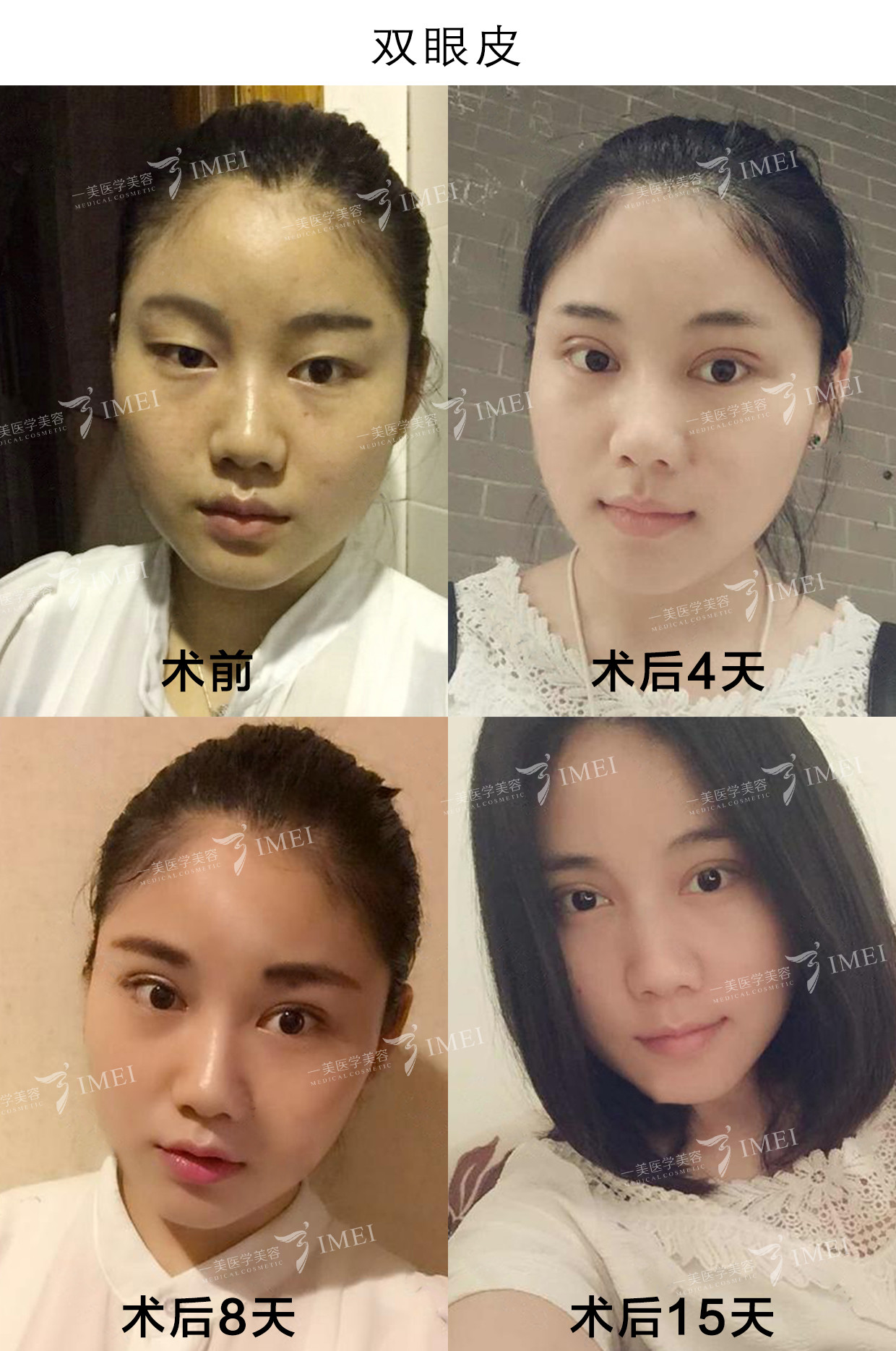 【眼综合】全切无痕 开眼角,20年权威打造达人招募