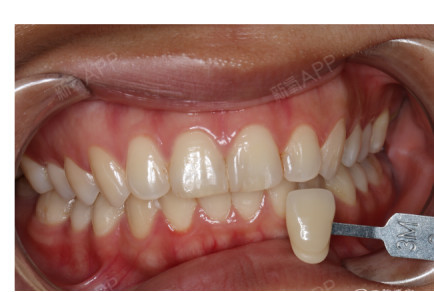 由此可看到牙齒顏色比較黃,達到3m2,經過簡單潔治拋光之後開始冷光