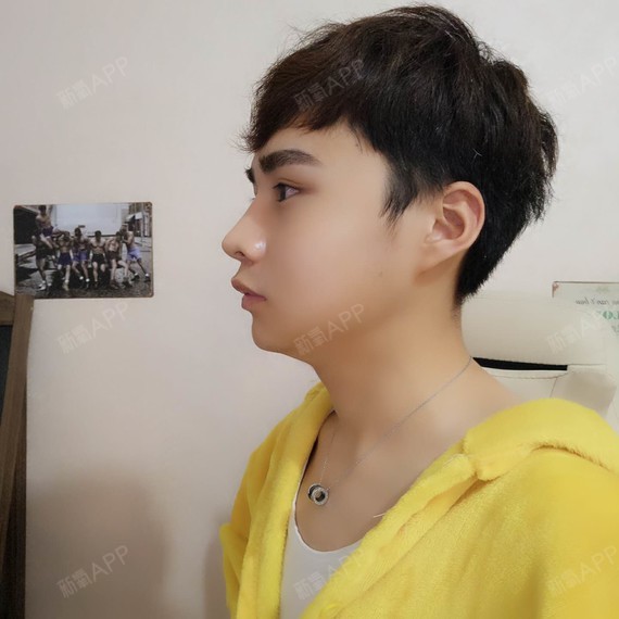 不是我刻意追求饱满,而是术前我额头凹陷,苹果肌也没有,所以显得整个