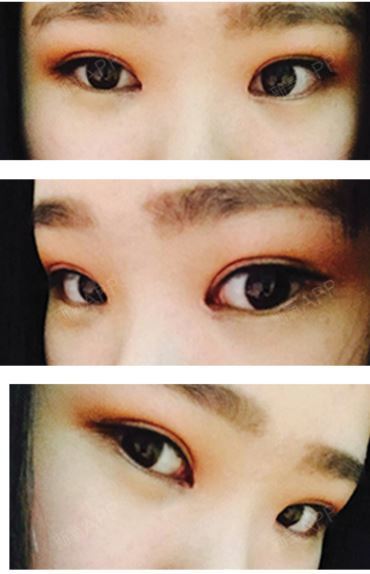 [韩国整形- 双眼皮切开法做了2个月]