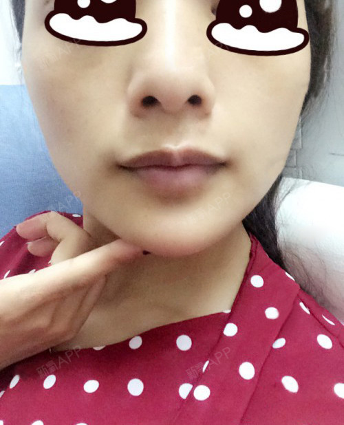第十五天啦,下巴越来越自然了,朋友都说做的很成功,_圈子-新氧美容