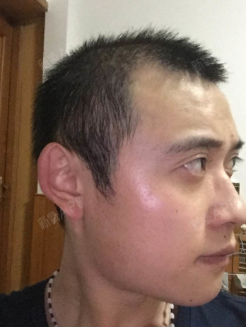 长出来了,虽然也是一笔费用,但为了以后现在想想还是对的,植发比较慢