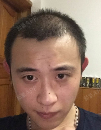 长出来了,虽然也是一笔费用,但为了以后现在想想还是对的,植发比较慢