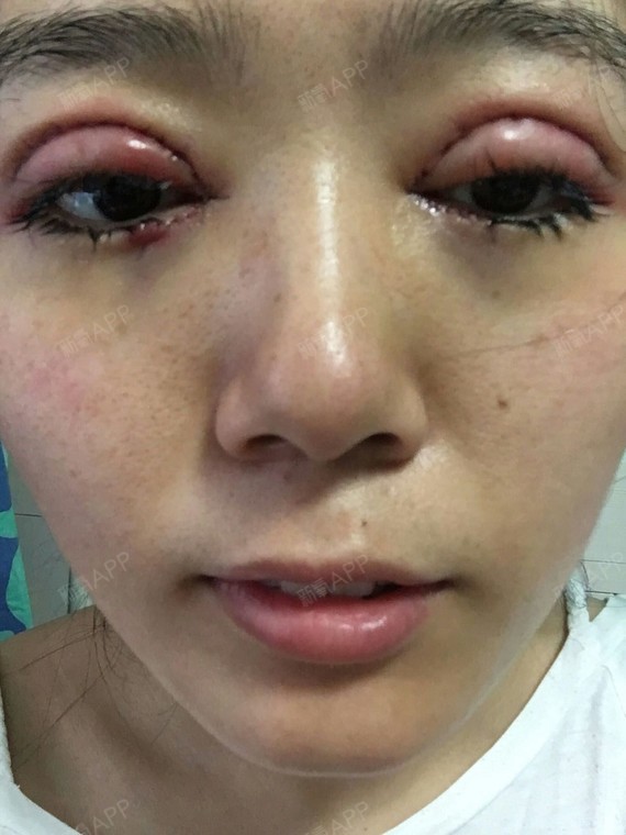 上海切开双眼皮好不好_效果图_du心已停机h切开双眼皮术后第2天_新氧