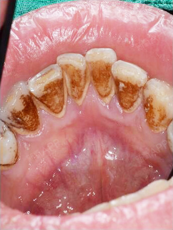 此顾客口腔清洁差,导致牙石堆积,因为长期喝咖啡导致_圈子-新氧美容