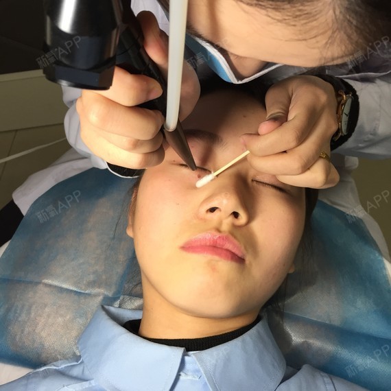 张小小520激光点痣第0天美丽日记