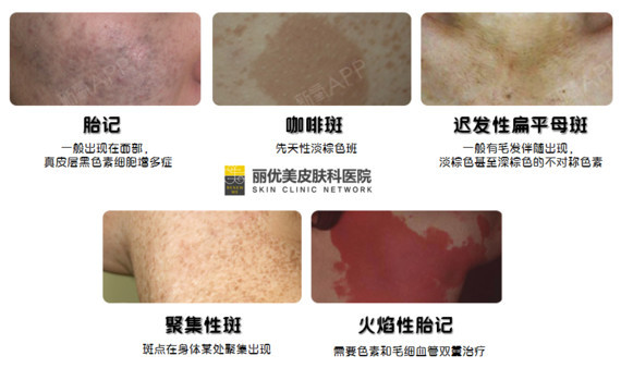 咖啡斑和雀斑的区别?】