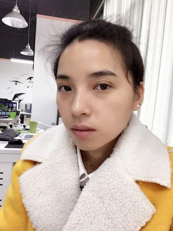 我在好美整形割双眼皮已经两个月了,现在的眼睛非常漂_圈子-新氧美容