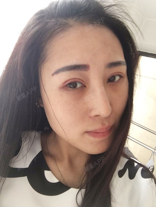 三天了,可能因为眼线部位的皮肤比较嫩,所以还稍微有_圈子-新氧美容