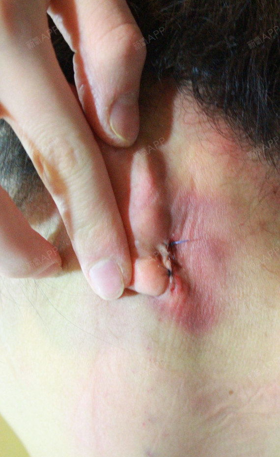 之前也说了这个耳后四颌角手术是郑院长的专利让我鼓起勇气做了