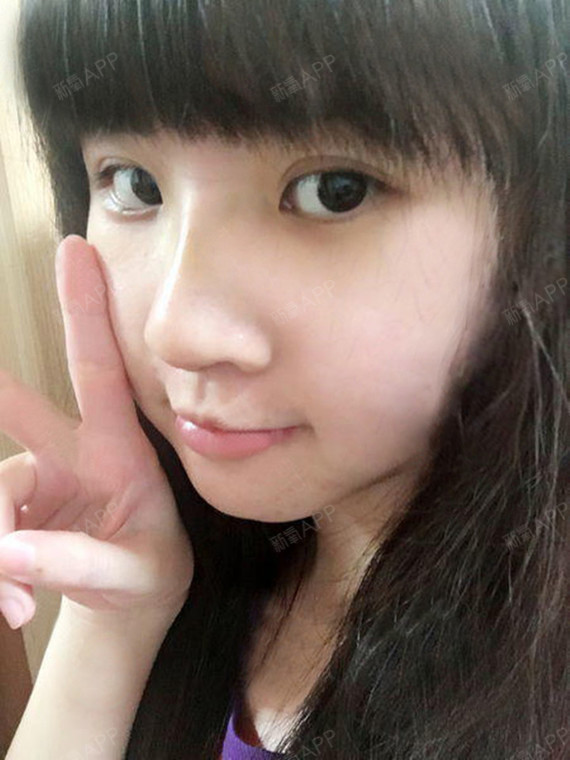 第一次打玻尿酸感觉吸收有点快,现在鼻子没有刚打完那么翘了(也有可能