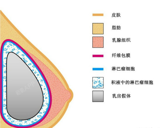 玻尿酸丰胸注射层次图片