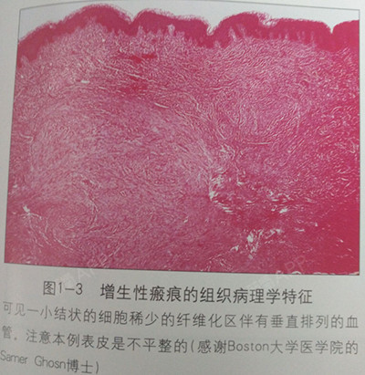 【瘢痕体质的诊断与治理】