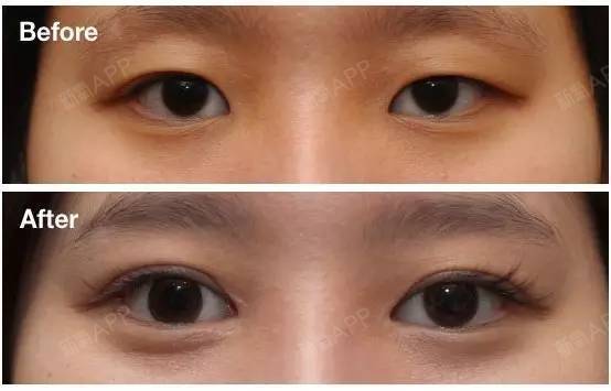 做双眼皮,风险到底大不大?