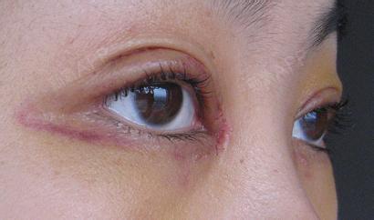 【开眼角会损伤眼睛吗?】