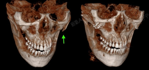 這是在我們醫院做了顴骨修復的患者的ct.