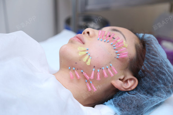 瞧这植入的一圈圈蛋白线,等这些蛋白线植入好后,我的苹果肌,法令纹