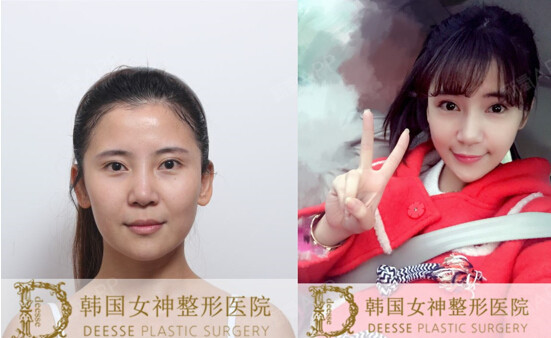 整形新技术】完美脸型的新标准"x切骨v-line术_圈子-新氧美容整形