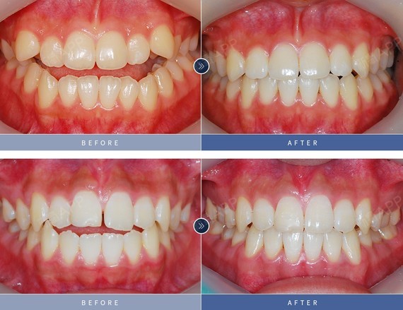 这两个病例都是前牙开合,不能切断食物,轻度的开唇露_圈子-新氧美容整