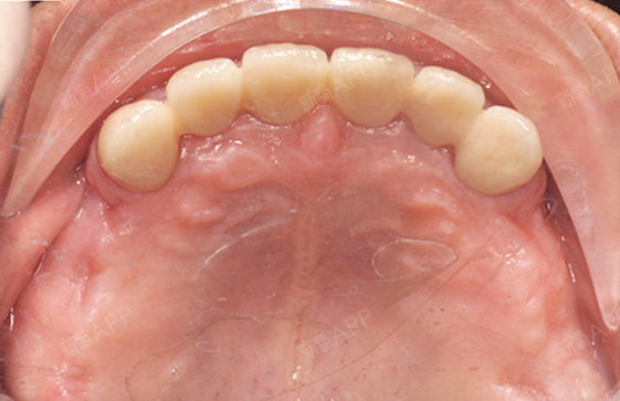 患者,男,66岁,上颌双侧后牙游离缺失,前牙3-3全瓷冠修复,左下45临时冠