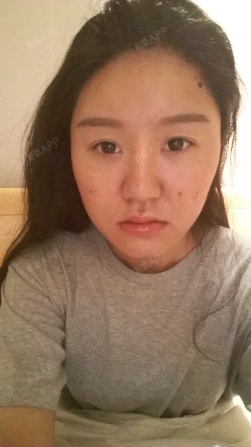 填充前额头平鼻基底凹陷特别严重眼睛下面部位也特别平在一个嘴巴也很