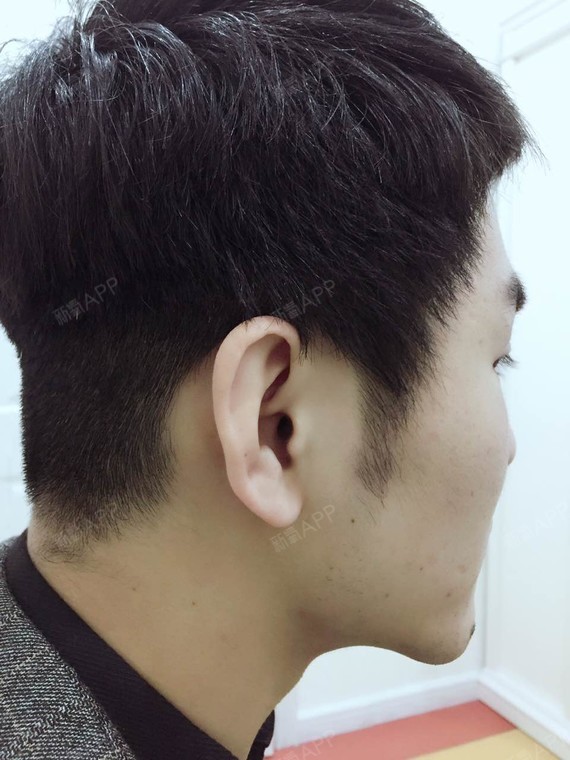 今天是我做疤痕种植还有鬓角种植的第9天,现在我的鬓_圈子-新氧美容