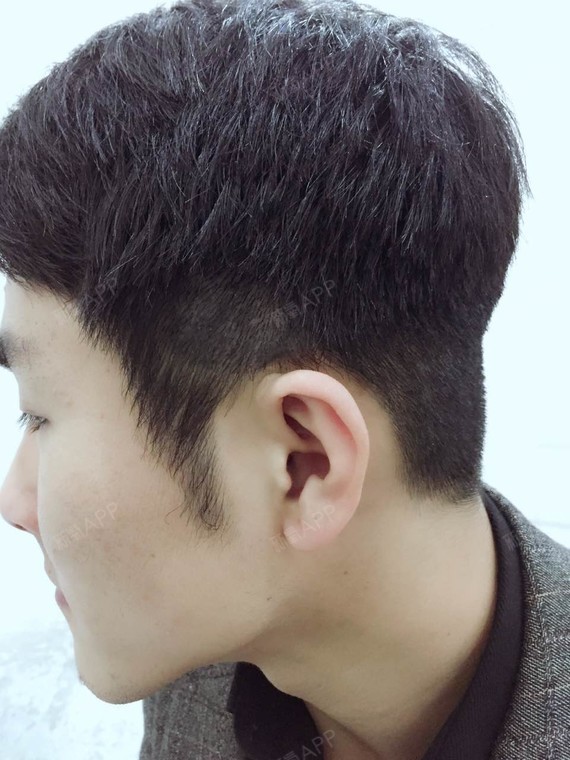 今天是我做疤痕种植还有鬓角种植的第9天,现在我的鬓_圈子-新氧美容