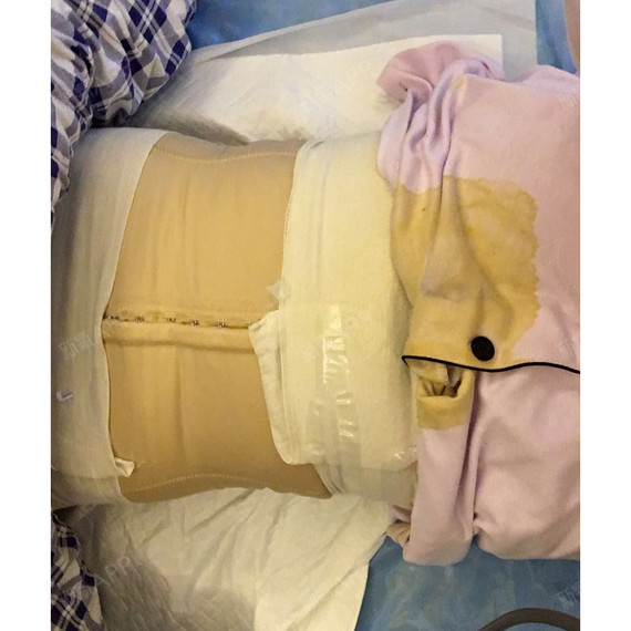 吸脂瘦腰部好不好_效果图_一个随便的名字吸脂瘦腰