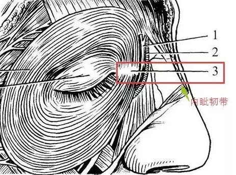 1,内眦韧带固定过前了