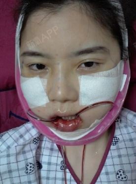 手术当天/石润院长给做的颧骨颧弓缩小术vline手_圈子-新氧美容整形