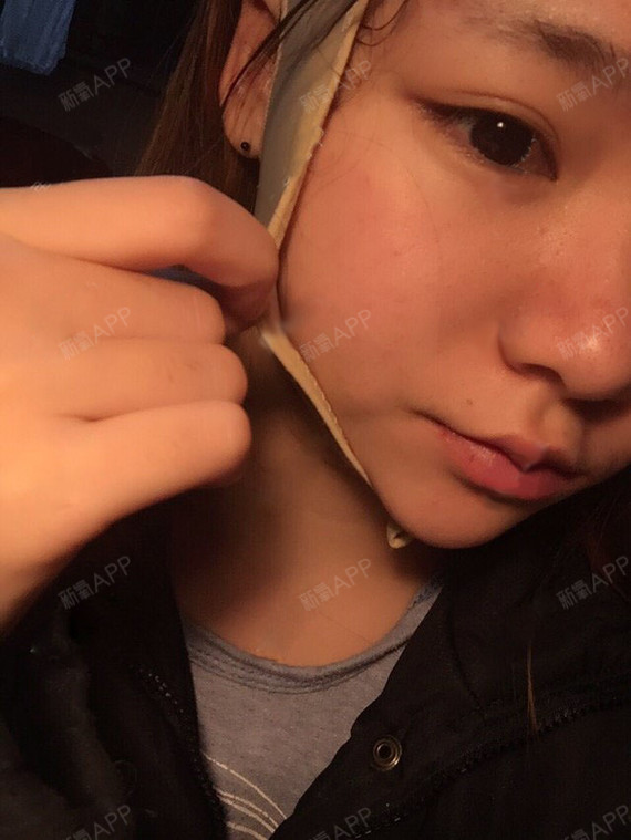 术后第五天本来今天应该去拆线的但是在家躺尸不想动