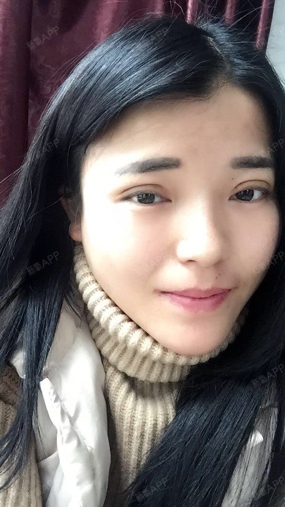 长沙埋线双眼皮好不好_效果图_勿忘初衷的你埋线双眼皮术后第10天