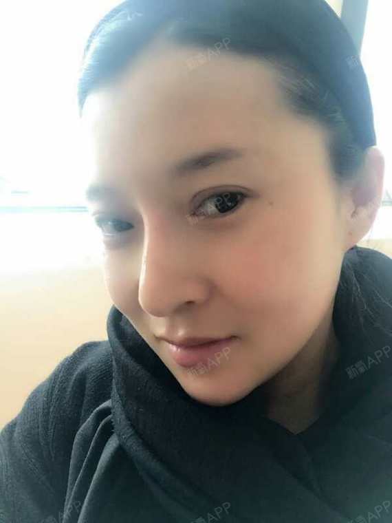 今天是第二天我觉得线雕隆鼻恢复的挺快的我觉得线雕隆_圈子-新氧美容