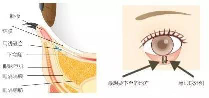 下睑下至是一种什么手术?