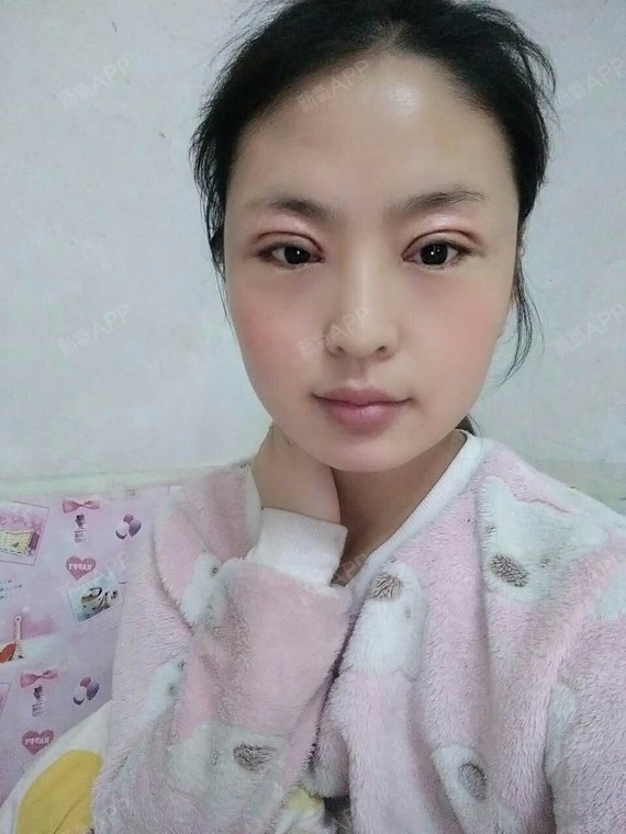 定点双眼皮好不好_效果图_nd896777定点双眼皮术后第3天_新氧美容整形