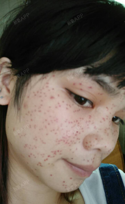 刚做完手术后,脸上就布满了密密麻麻的红点,治疗后刚_圈子-新氧美容