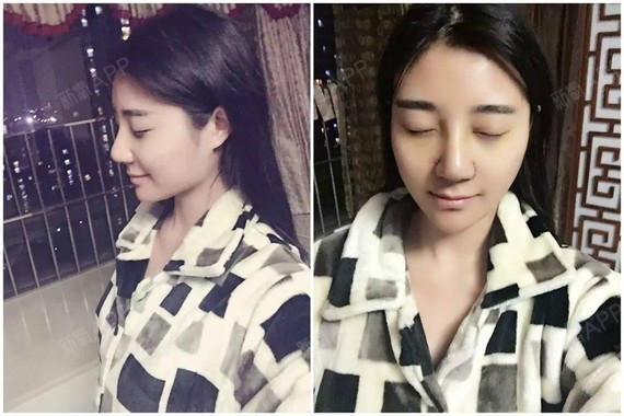 新氧- linda_琳达o0o | 鼻部 | 鼻头整形 | 自体软骨垫鼻尖 | 术后当