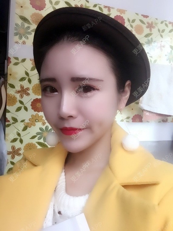 武汉自体脂肪全脸填充好不好_效果图_gu7656自体脂肪全脸填充术后第30