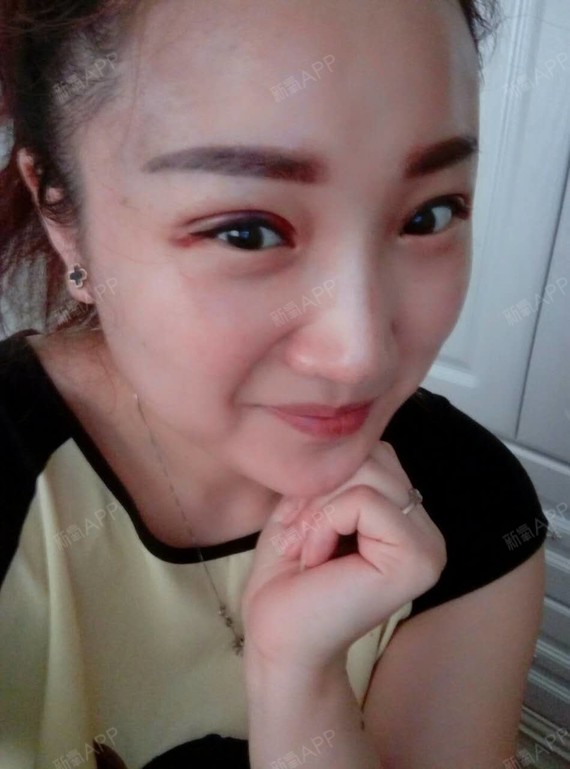 术后五天拆线术后一个月效果术后三个月_圈子-新氧美容整形