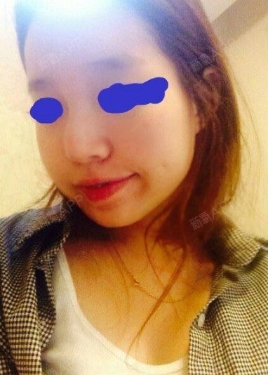 从小就因为我的阴沟鼻没自信,感觉鼻头偏大.想去韩国_圈子-新氧美容整